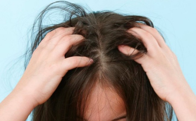 উকুনের সমস্যা থেকে চিরকাল মুক্ত থাকুন খুবই সহজ ২ টি উপায়ে!